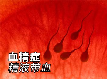 固原血精症治疗,血精预防.血精诊断