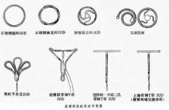 取环后不孕怎么办？